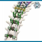 SISTEMA DE FIXAÇÃO DA COLUNA VERTEBRAL